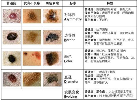 身上痣|痣是什麼？會變成黑色素瘤？7種一定要除的痣